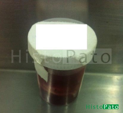 Material mal fixado em solução fisiológica